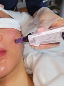 Water Light Anti-Wrinkle Micro-Needling